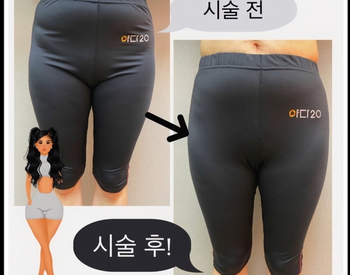 힙딥필러~~ 효과 짱!! 