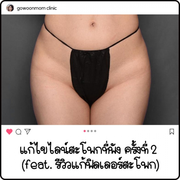 แก้ไขไลน์สะโพกที่พังครั้งที่ 2 (feat. รีวิวแก้ฟิลเลอร์สะโพก)