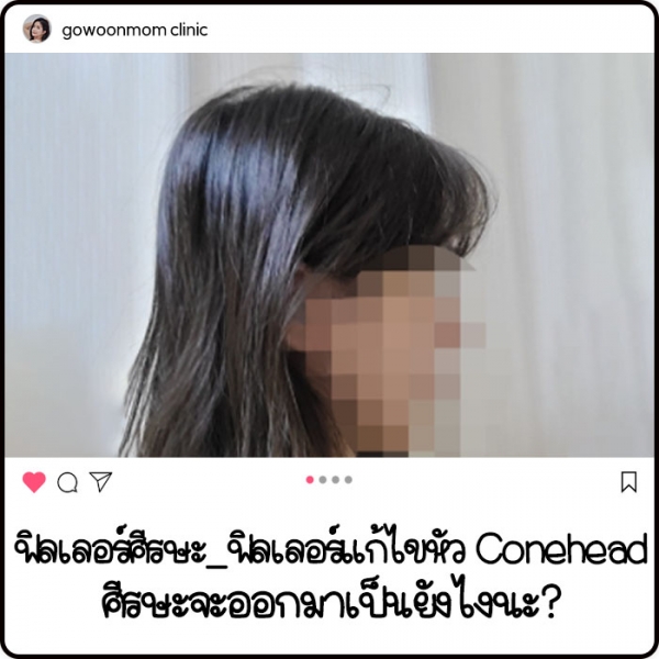 ฟิลเลอร์แก้ไขหัว Conehead ศีรษะจะออกมาเป็นยังไงนะ?